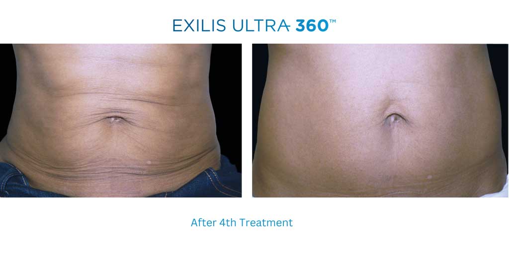 Why Exilis Is Still The Best Skin Tightening Treatment