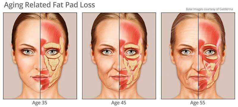 The Aging Face (Part 2): Fat Planes & Muscle Dynamics