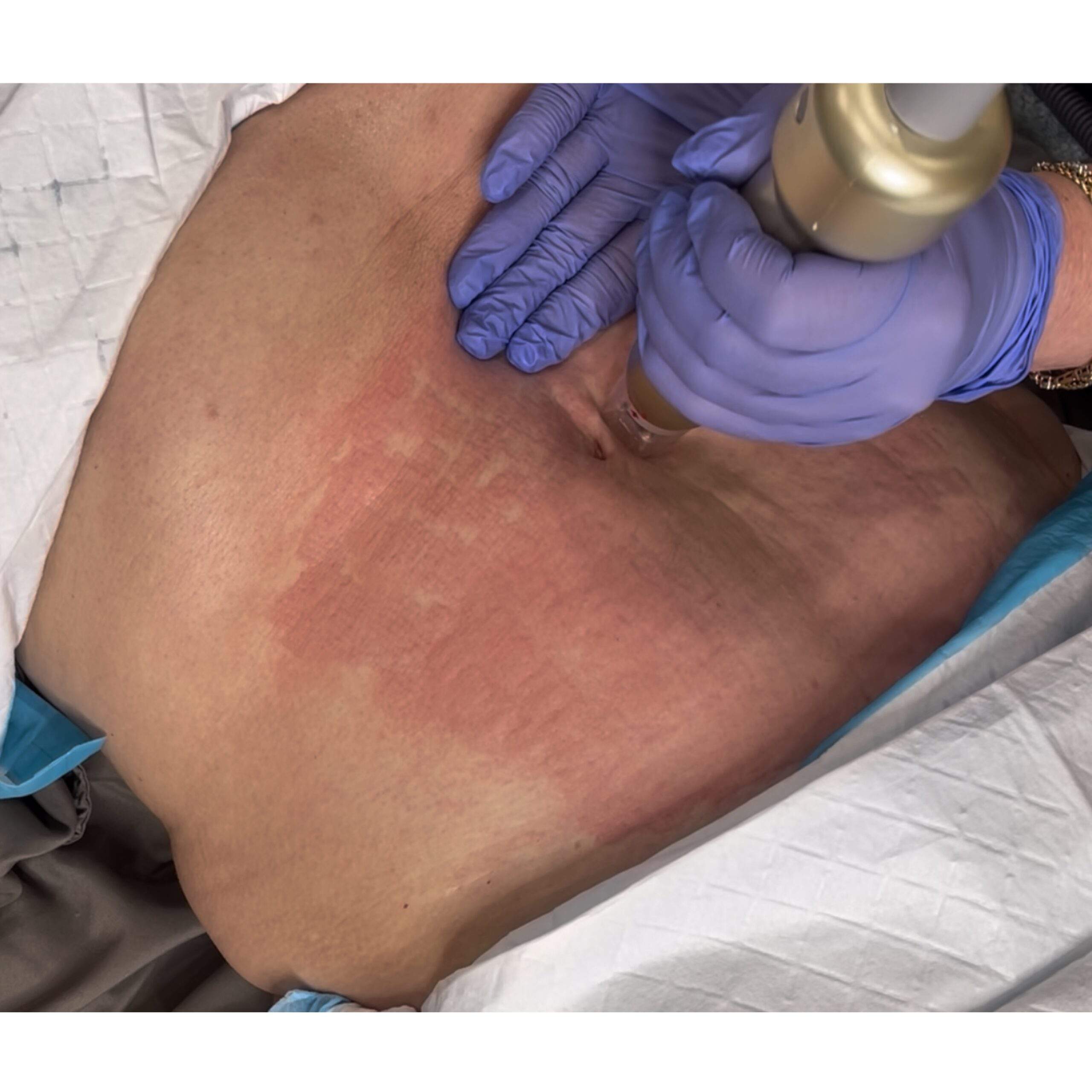 Non-surgical skin tightening treatment in North Scottsdale at Contour You Med Spa