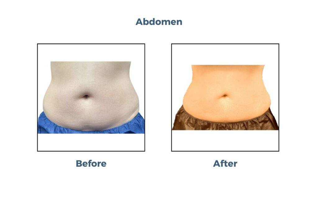 Coolsculpting Elite Offer
