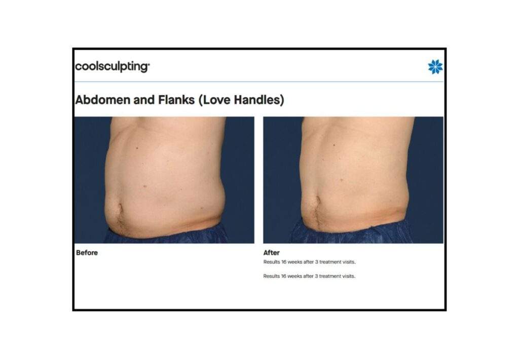 Coolsculpting Elite Offer