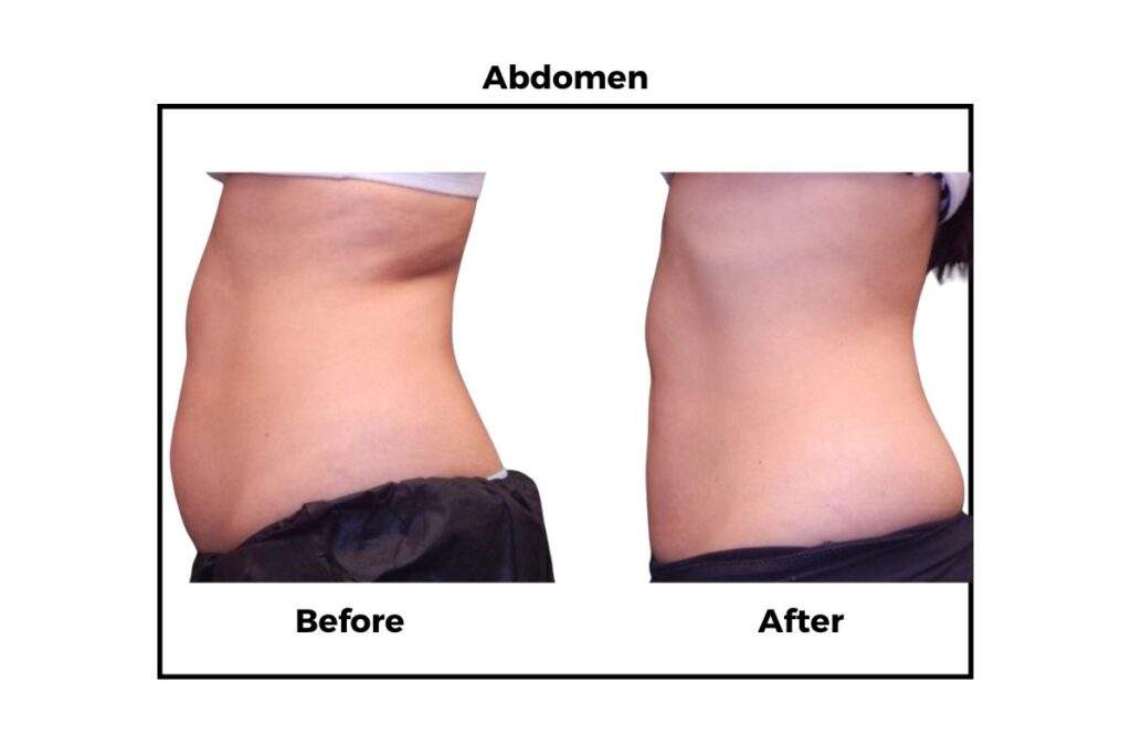 Coolsculpting Elite Offer